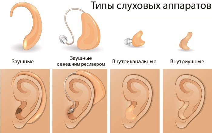 Høreapparat til ældre. Pris, hvordan man vælger, hvor man kan købe, anmeldelser