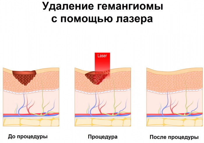 Hemangioma pada kulit. Foto, USG, deskripsi