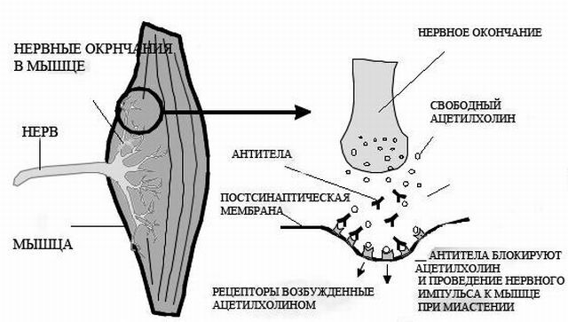 Der Mechanismus der Myasthenia gravis