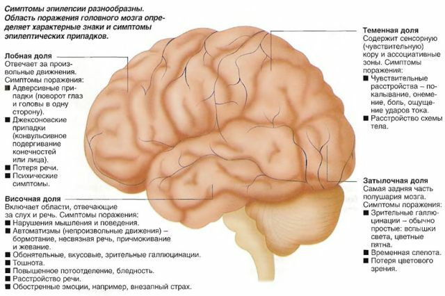 Types of epilepsy