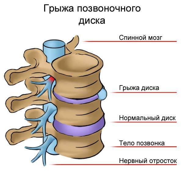 Intervertebral hernia
