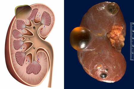 Muguri de rinichi