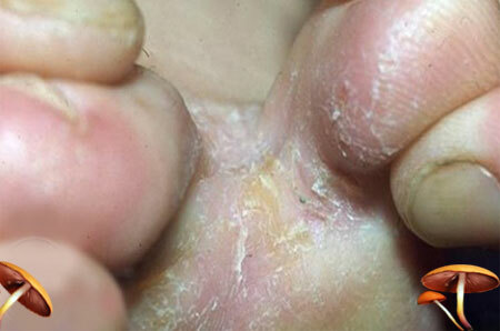 Fotografii ale simptomelor fungice ale piciorului