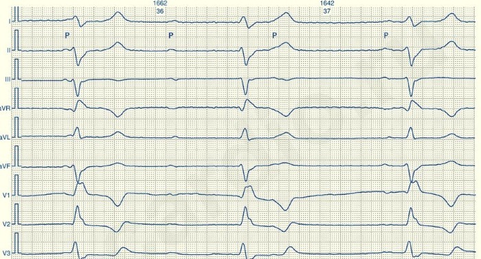 Idioventrikulaarne rütm EKG -l. Mida see tähendab, fotod, põhjused ja ravi