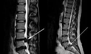 Painful horse-tail syndrome in the back area of ​​a man