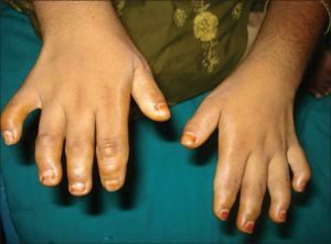 Brachydactyly - features of congenital anomaly of the extremities