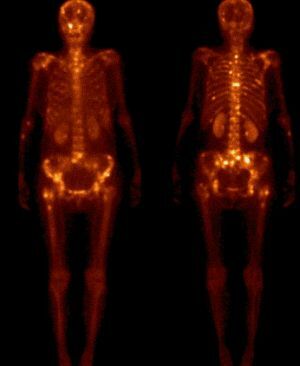 pathologie van de wervelkolom op het scannen van botten