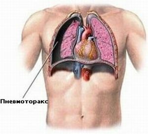 the appearance of hemothorax and pneumothorax