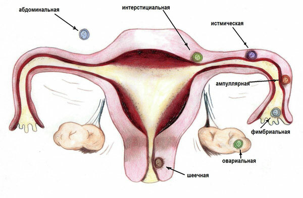 Ectopic pregnancy, layouts