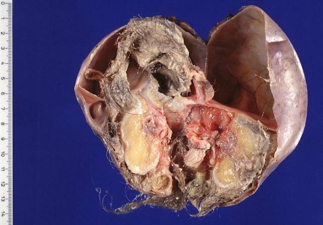 Terratoma ovarico