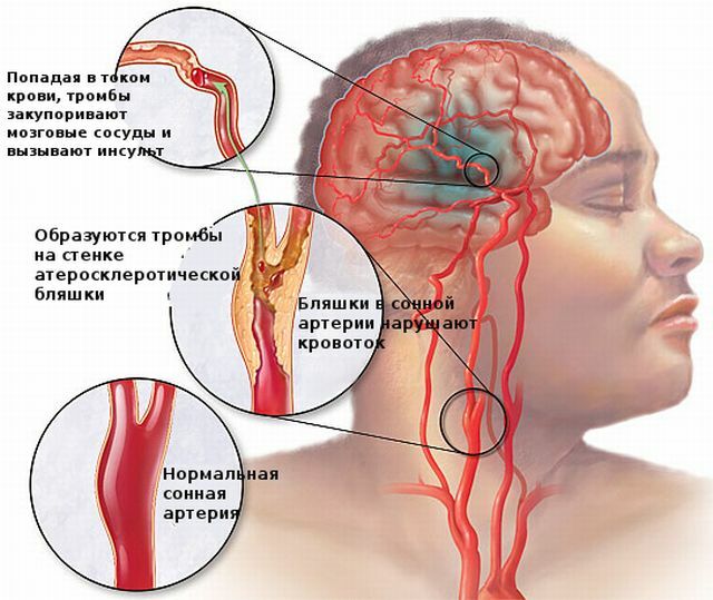 Formation of blood clots in the brain