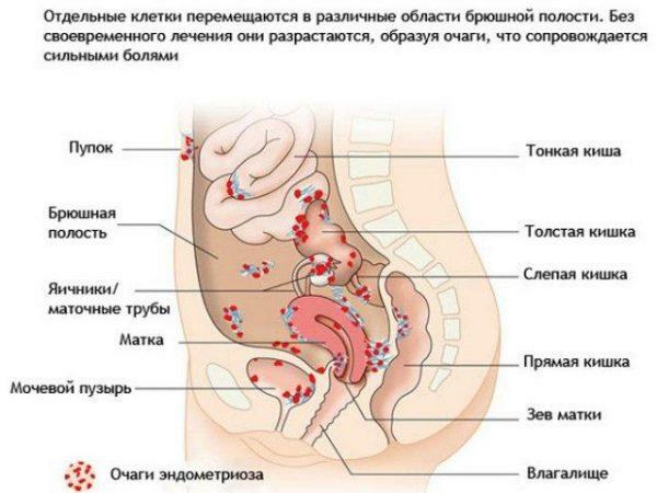 Endometrioosin paikat