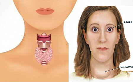 Simptomele bolii tiroidiene la femei
