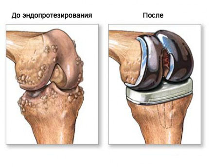 Funcționarea pe articulația genunchiului