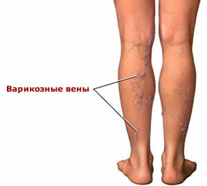 Treatment of veins on the legs