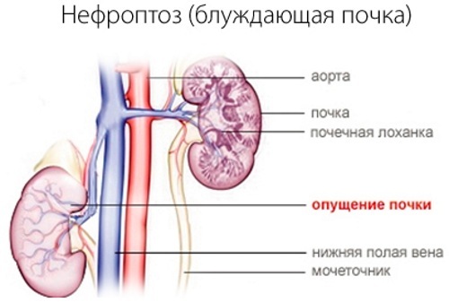 Descendența rinichiului la femei. Simptome și tratament, cauze