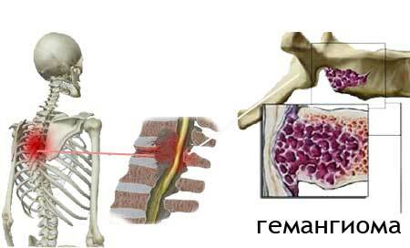 Skeleta hemagioma( mugurkaula) simptomi un ārstēšana, briesmas