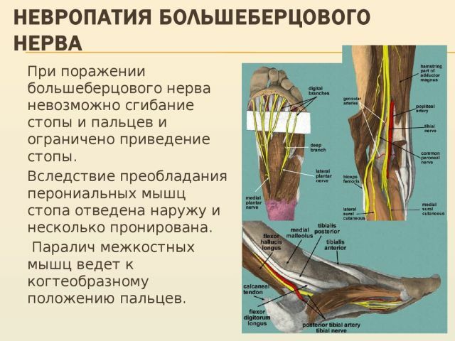 Neuropati dan luka lain dari saraf tibialis