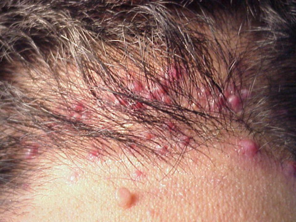 Acne in the scalp