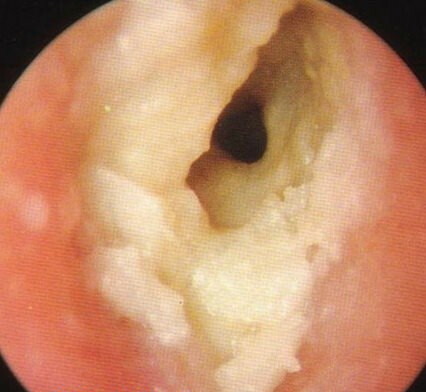 White plaque in the ears of the child, behind the ear, inside. What to do