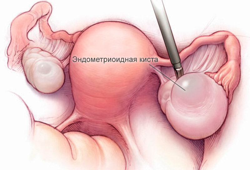 Hvordan løser ovariecysten?