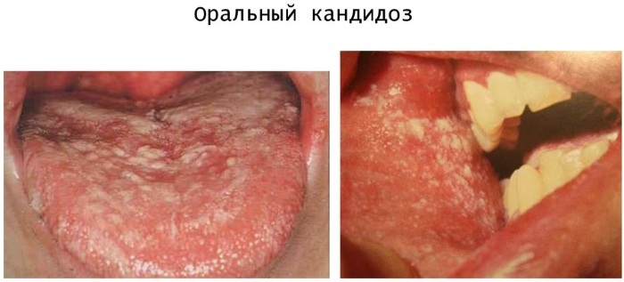 Stomatitis in the throat. Treatment, homeopathy during pregnancy, contagious or not, psychosomatics, is there a fever