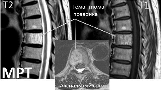 Hemangiom i vertebraens kropp l1-l2-l3-l4, th7-th10-th12. Hva det er