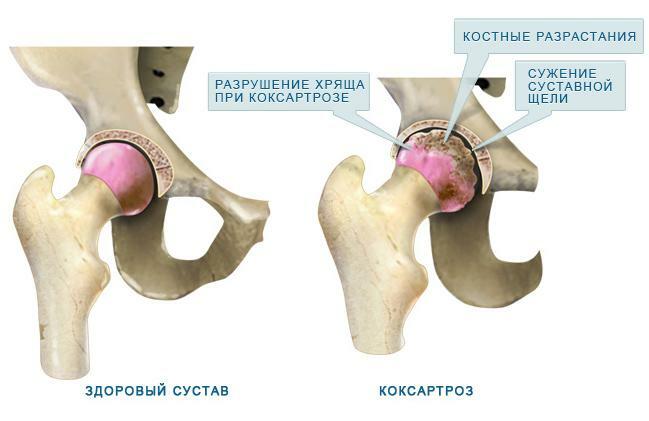 Um exemplo de uma estrutura de articulações saudáveis ​​e doloridas