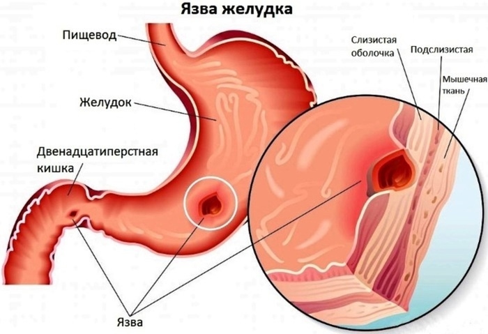 Magsår. Symtom och tecken hos vuxna, behandling, förfarande, kirurgi