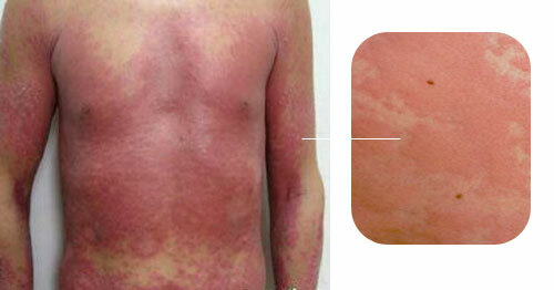 Urticaria in adults: symptoms and treatment, photo as it looks