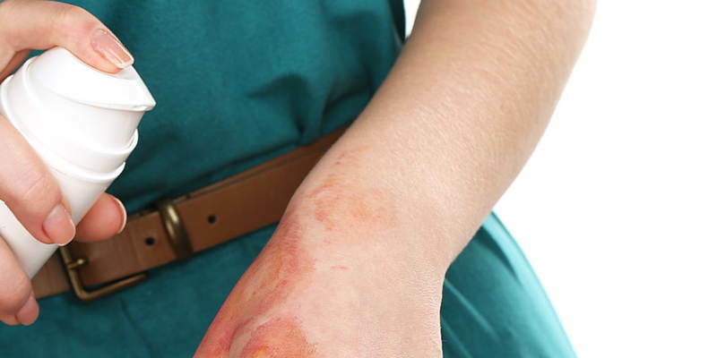 How to provide first aid for burns?