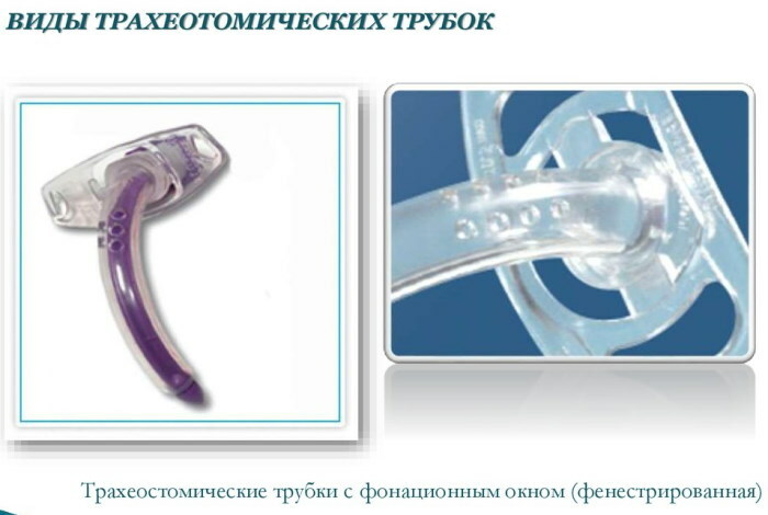 Traheostomie: un set de instrumente, tehnică, tipuri
