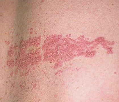 Lumbar lichen on the skin of a man