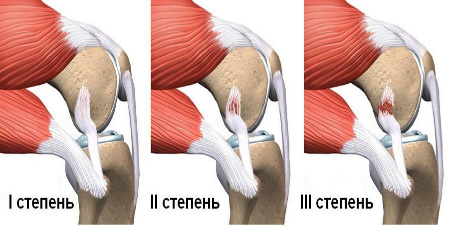 Determine the rupture of the knee ligament
