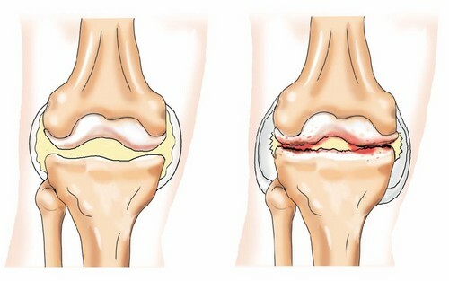 Arthrose artritis van het kniegewricht