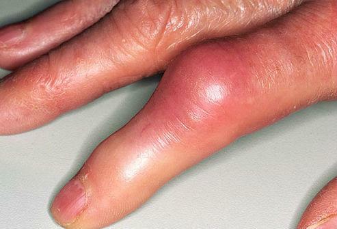 Arthritis of the finger. Redness