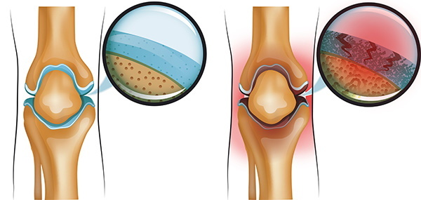 Arthrite du genou. Traitement de 1-2 degrés, médicaments, onguents