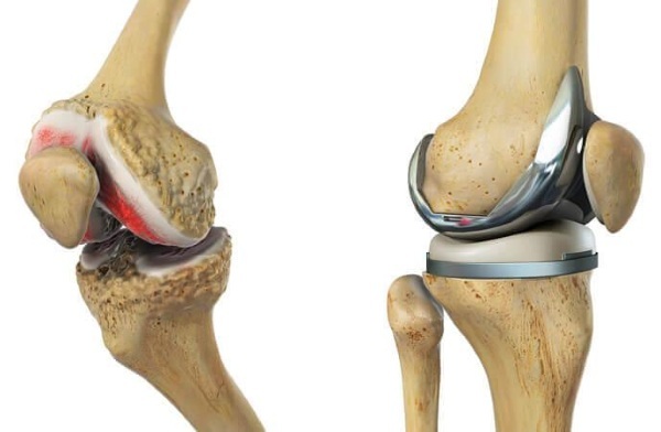 Knee endoprosthesis. Price, types, service life, photos, reviews. Zimmer, Stryker, Biomet
