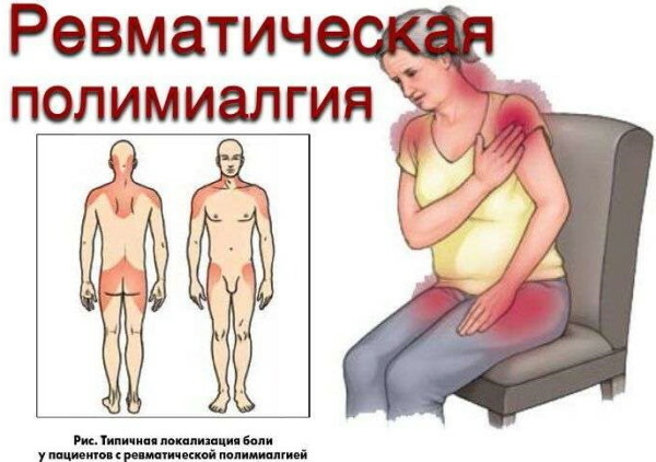 Polymyalgia rheumatica. Symptoms and treatment in adults