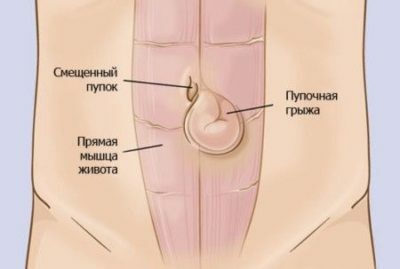 Tratamiento de la hernia umbilical después del embarazo( parto)