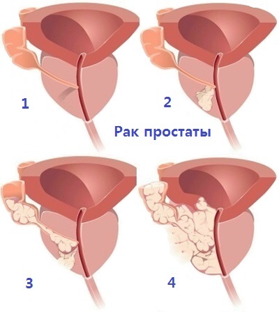 Prostatas vēzis