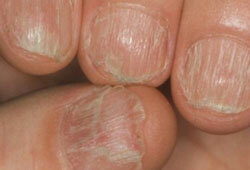 behandeling van de schimmel van de nagel van verwaarloosde vorm