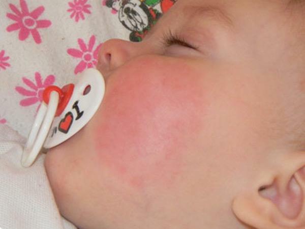 Diatesis en las mejillas de un niño: tratamiento