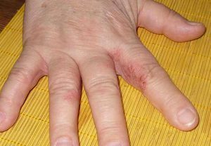 rash on the hands