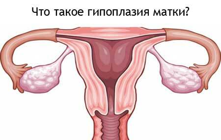 Hypoplasie van de baarmoeder - wat is het?