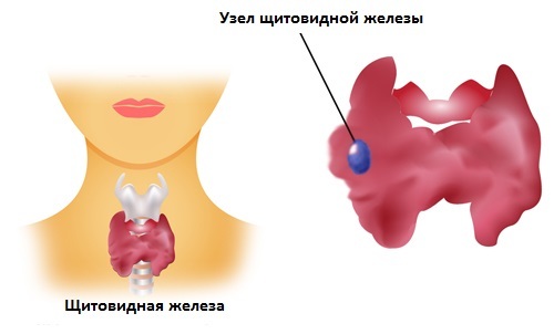 Colloid nodes of the thyroid gland
