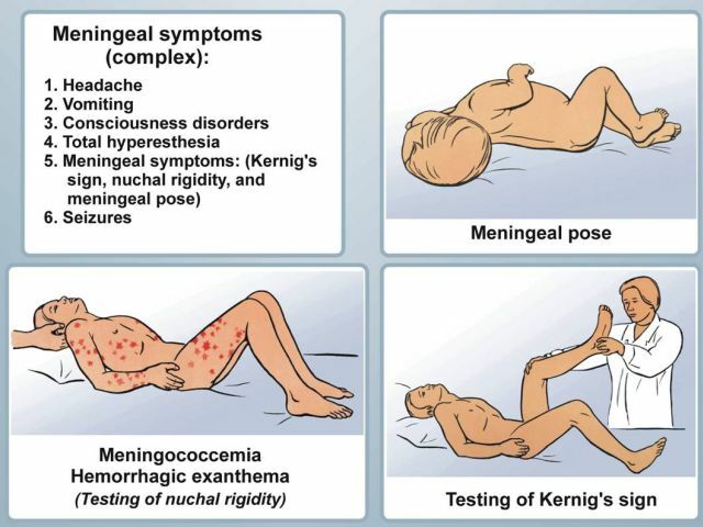 meningeāla simptomi