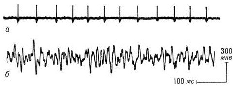 EMG (elektromyografi) i nedre ekstremiteter. Hva er denne undersøkelsen