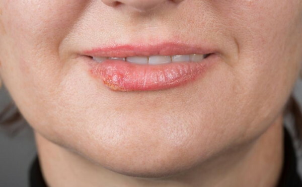Watery pimples on the lip. Reasons for what to do