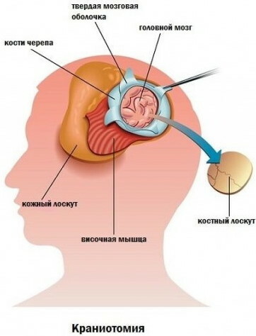 Suture métopique sur le front chez un enfant, craniosténose chez l'enfant. Tarif, traitement